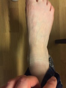 chirurgie mini invasive hallux valgus nancy-oignon pied medecin